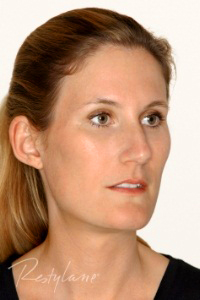 cheek enhancement